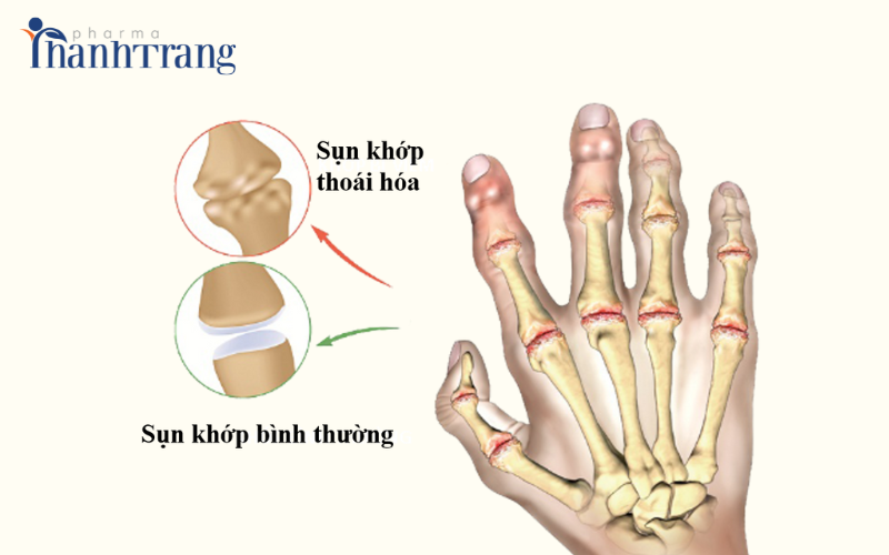 Sụn khớp thoái hóa